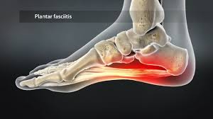 Does your foot hurt? It could be Plantar Fasciitis.